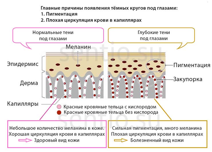 Причины появления тёмных кругов под глазами